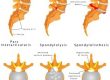 Lumbar_spondylosis3