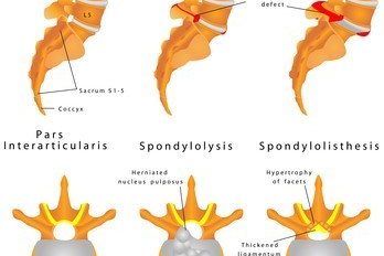 Lumbar_spondylosis3